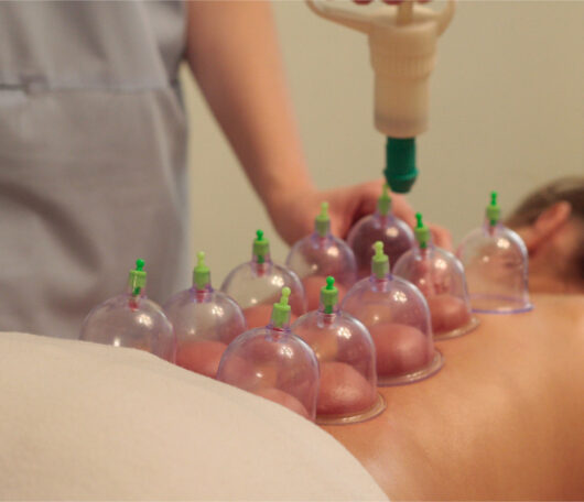 Cupping-Body-Massage